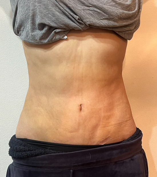 お腹の脂肪吸引