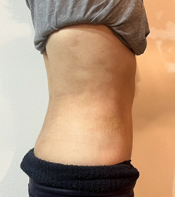 お腹の脂肪吸引