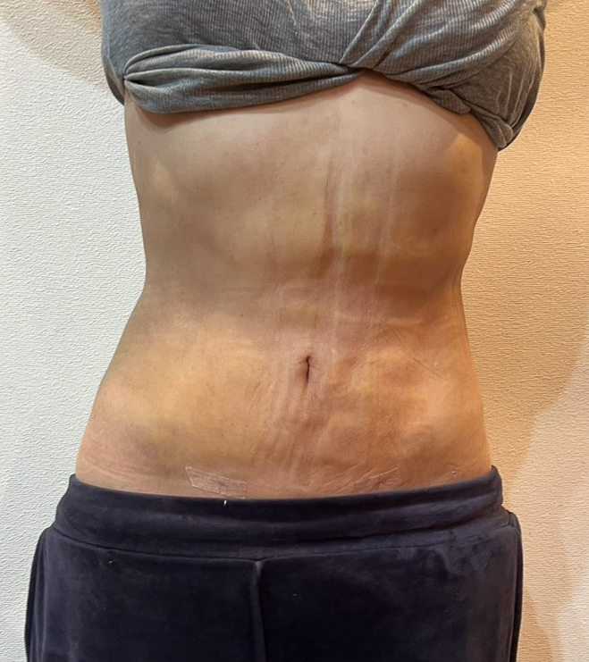 お腹の脂肪吸引