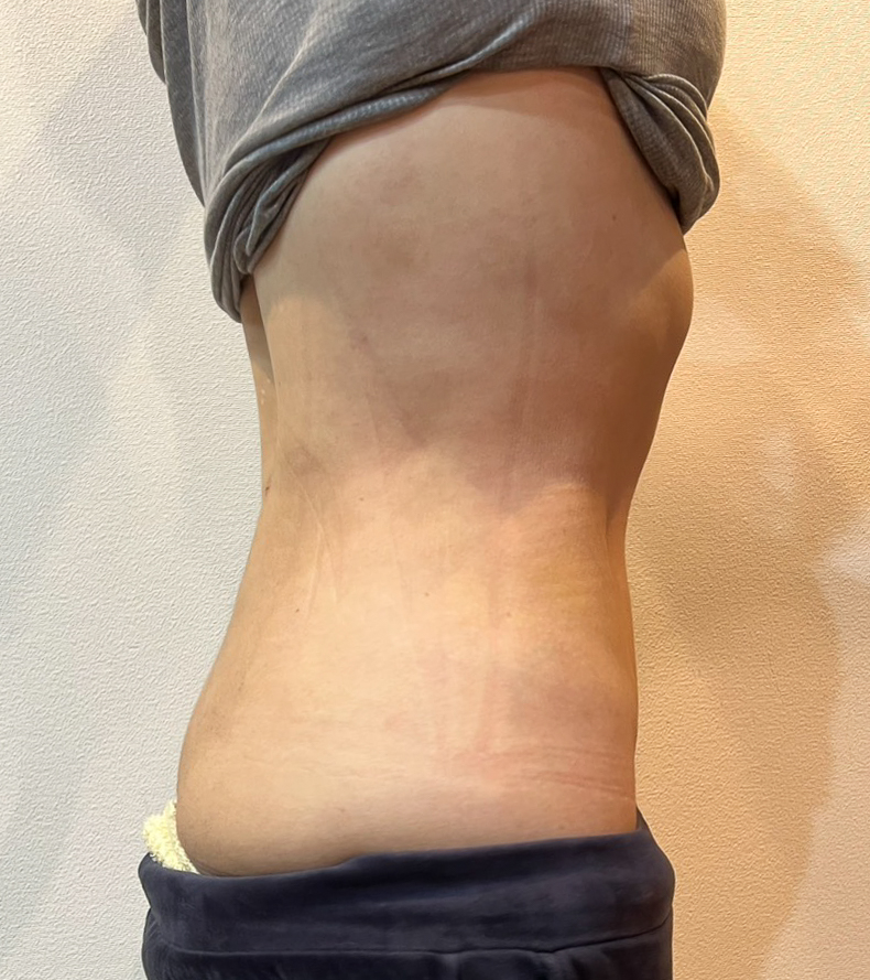 お腹の脂肪吸引