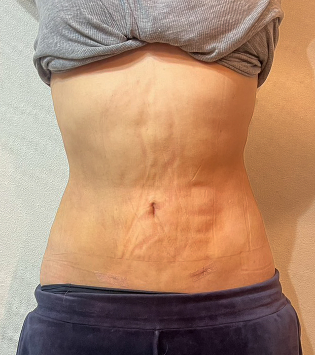 お腹の脂肪吸引