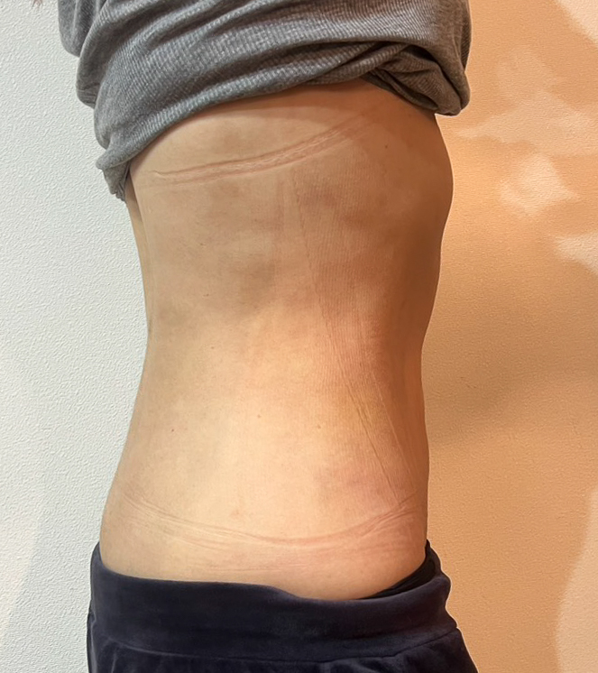 お腹の脂肪吸引