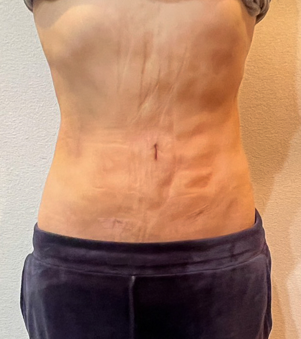 お腹の脂肪吸引