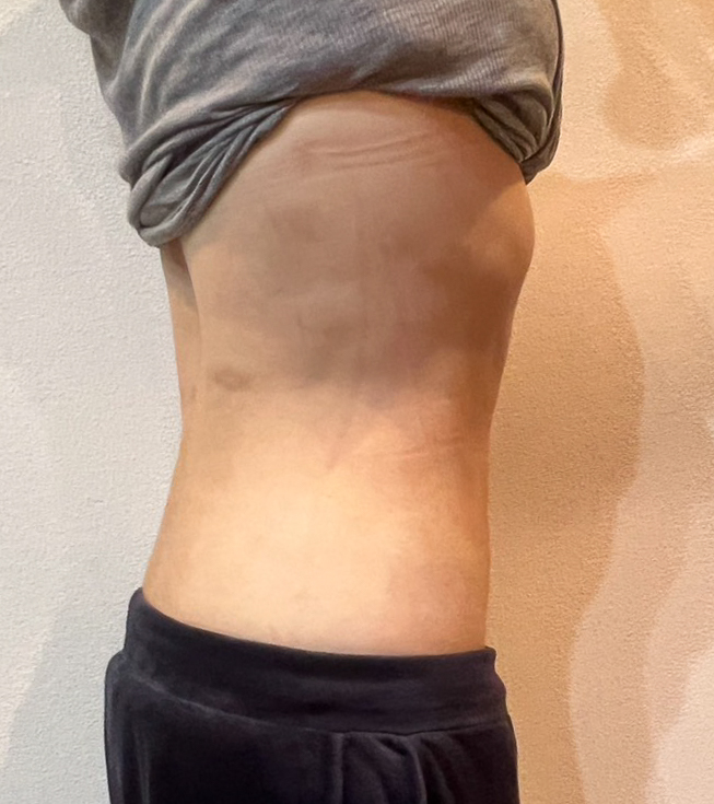 お腹の脂肪吸引