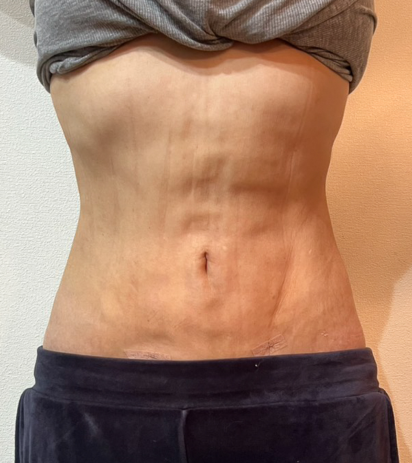 お腹の脂肪吸引