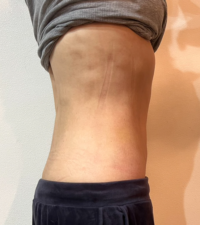 お腹の脂肪吸引