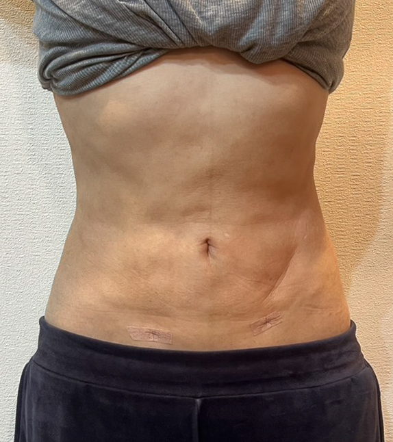 お腹の脂肪吸引