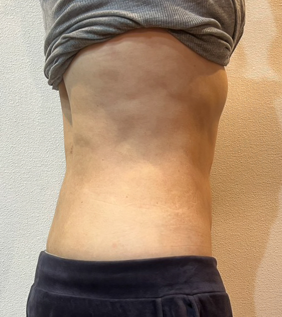 お腹の脂肪吸引