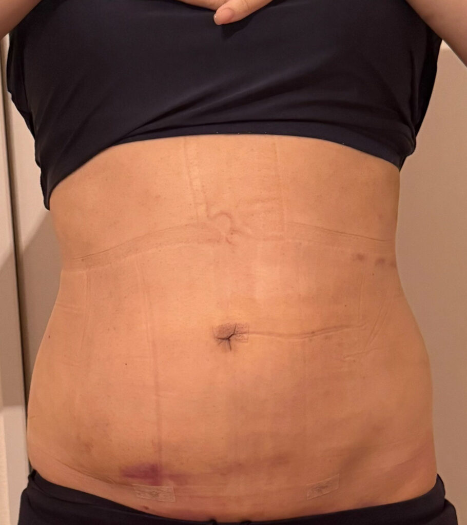 お腹の脂肪吸引