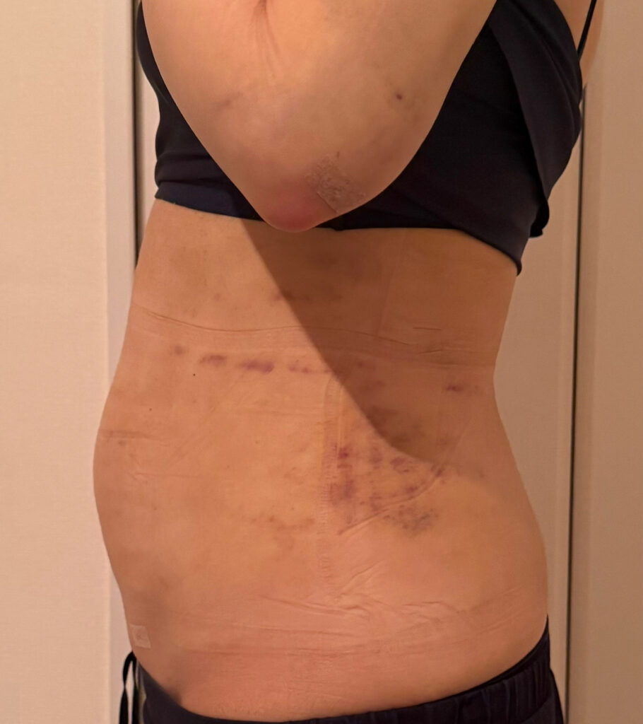 お腹の脂肪吸引