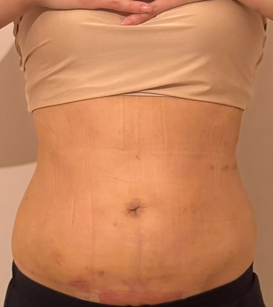 お腹の脂肪吸引