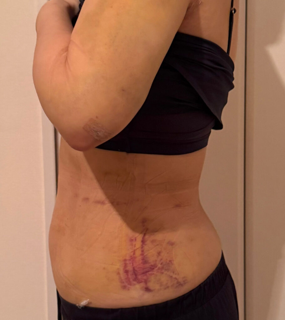 お腹の脂肪吸引