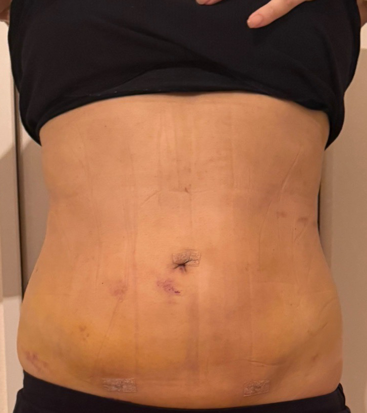 お腹の脂肪吸引