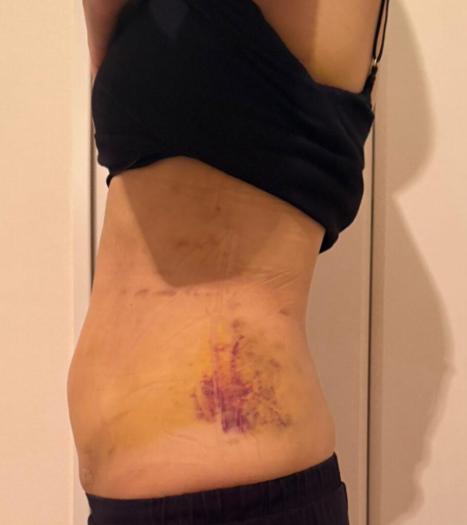 お腹の脂肪吸引