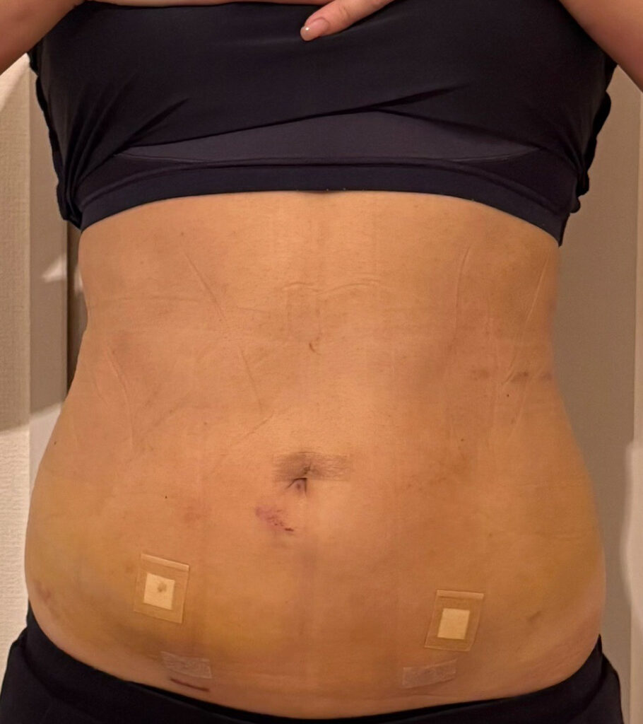 お腹の脂肪吸引