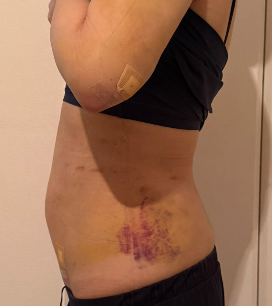 お腹の脂肪吸引