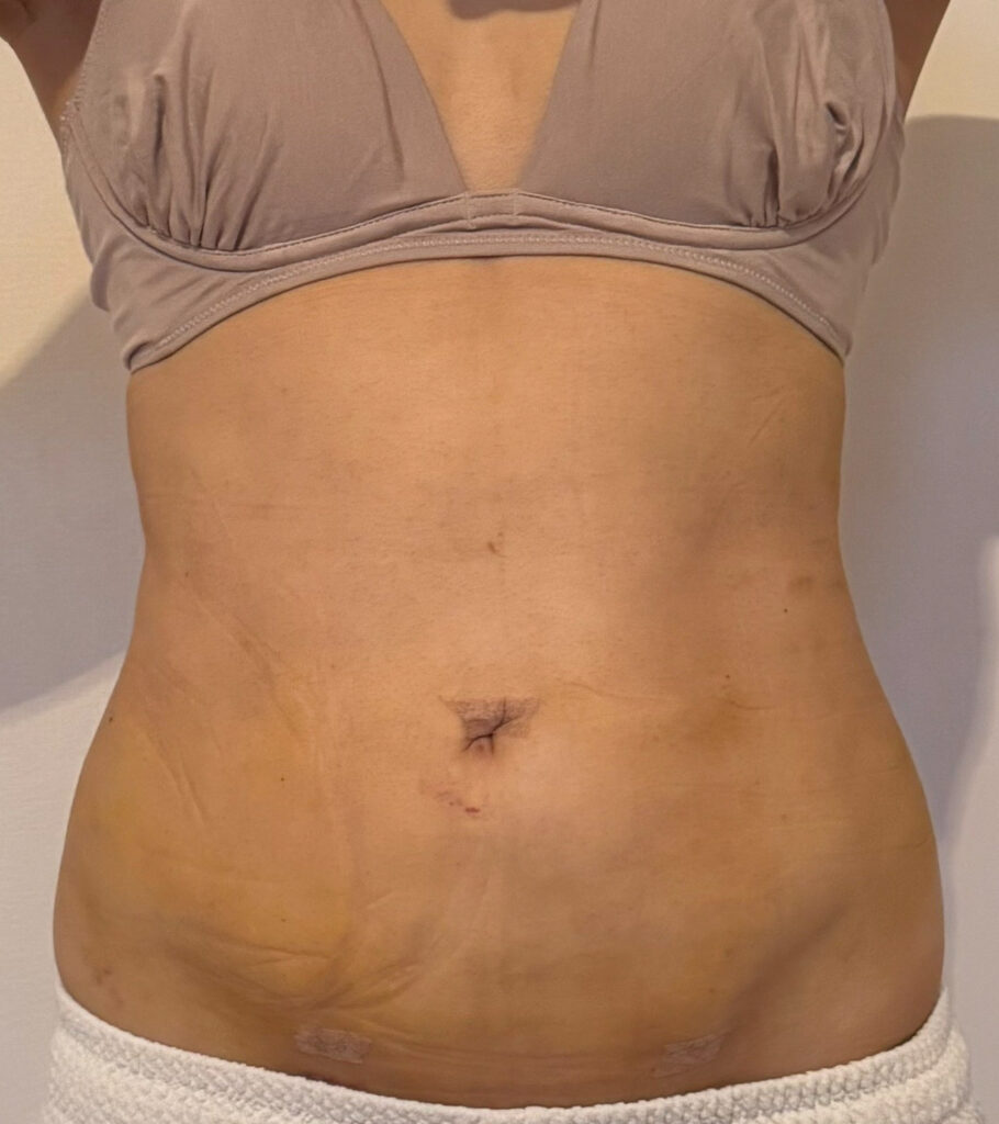 お腹の脂肪吸引