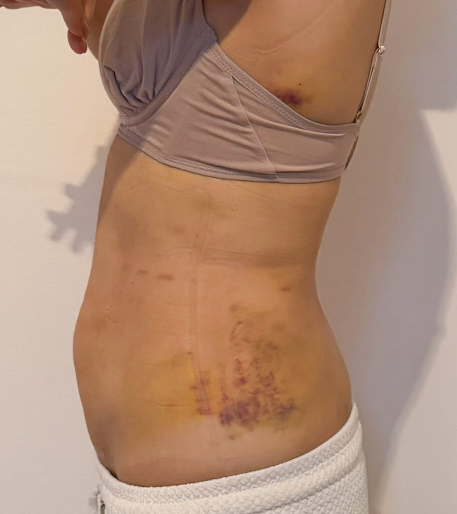 お腹の脂肪吸引