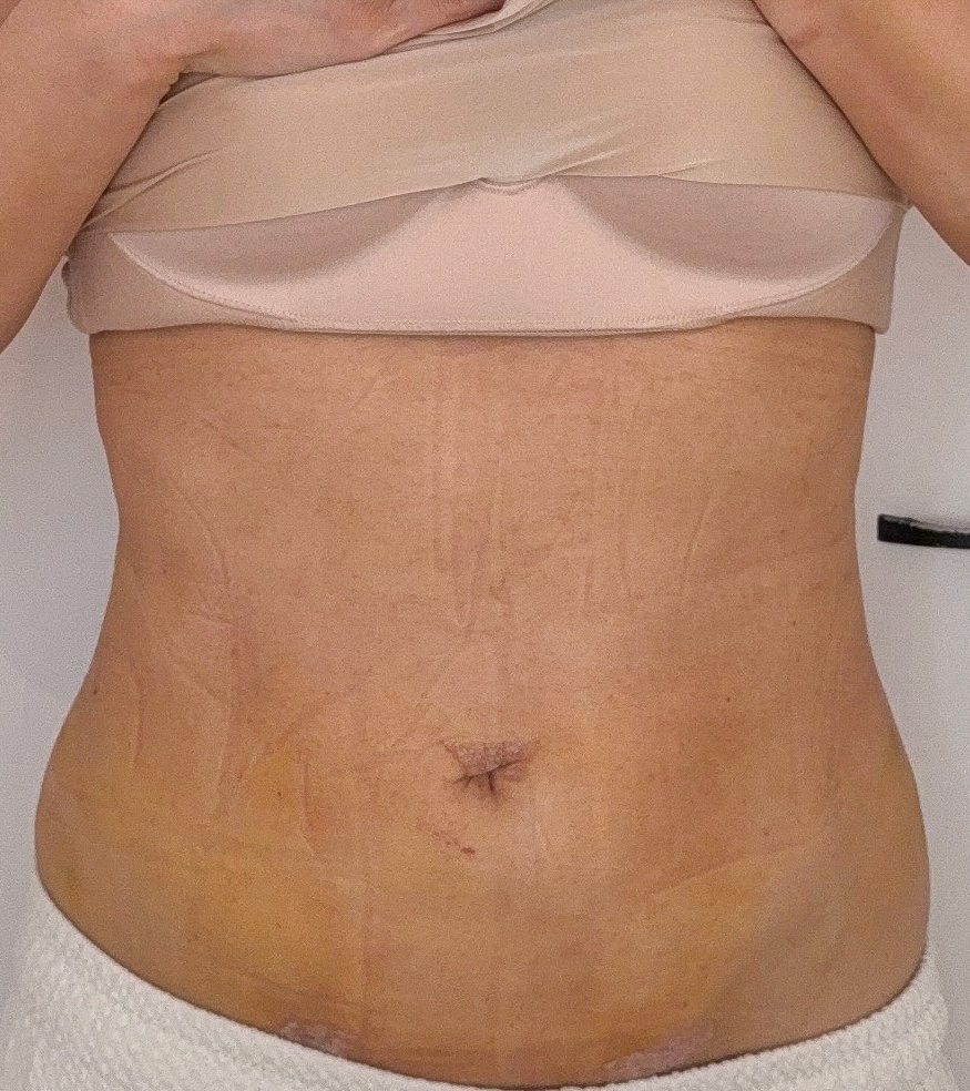 お腹の脂肪吸引