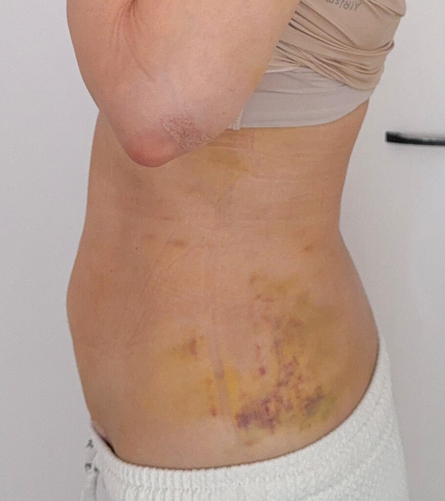 お腹の脂肪吸引