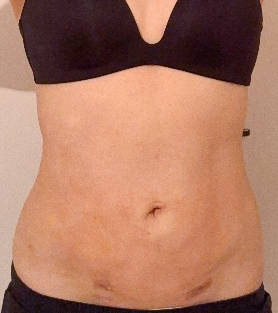お腹の脂肪吸引