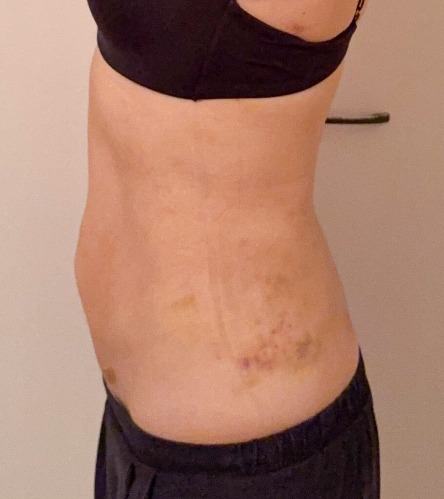 お腹の脂肪吸引