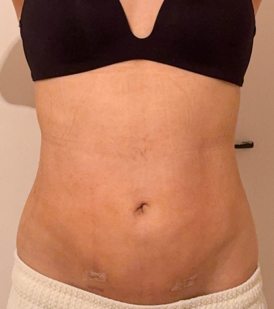 お腹の脂肪吸引