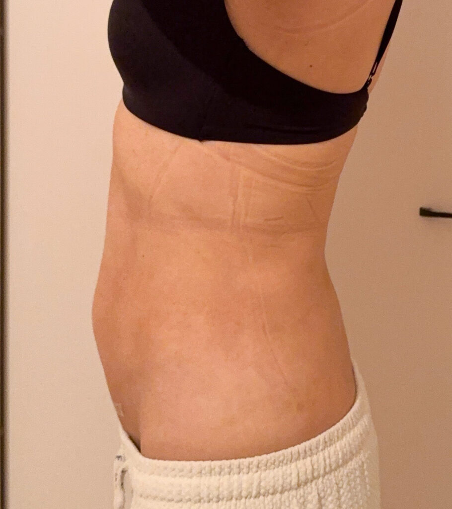 お腹の脂肪吸引