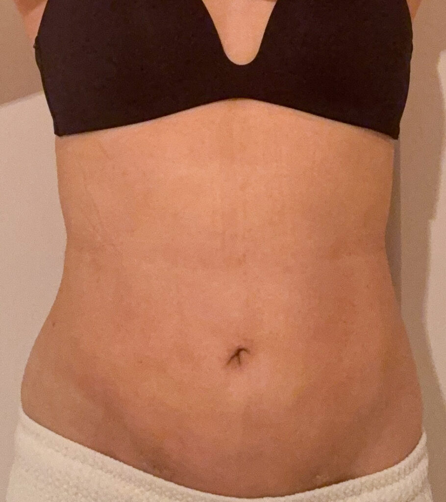 お腹の脂肪吸引