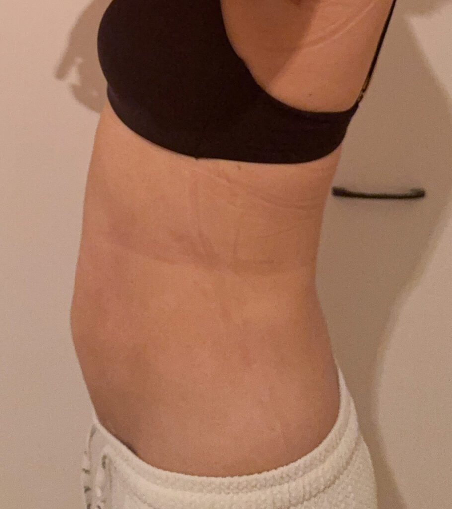 お腹の脂肪吸引