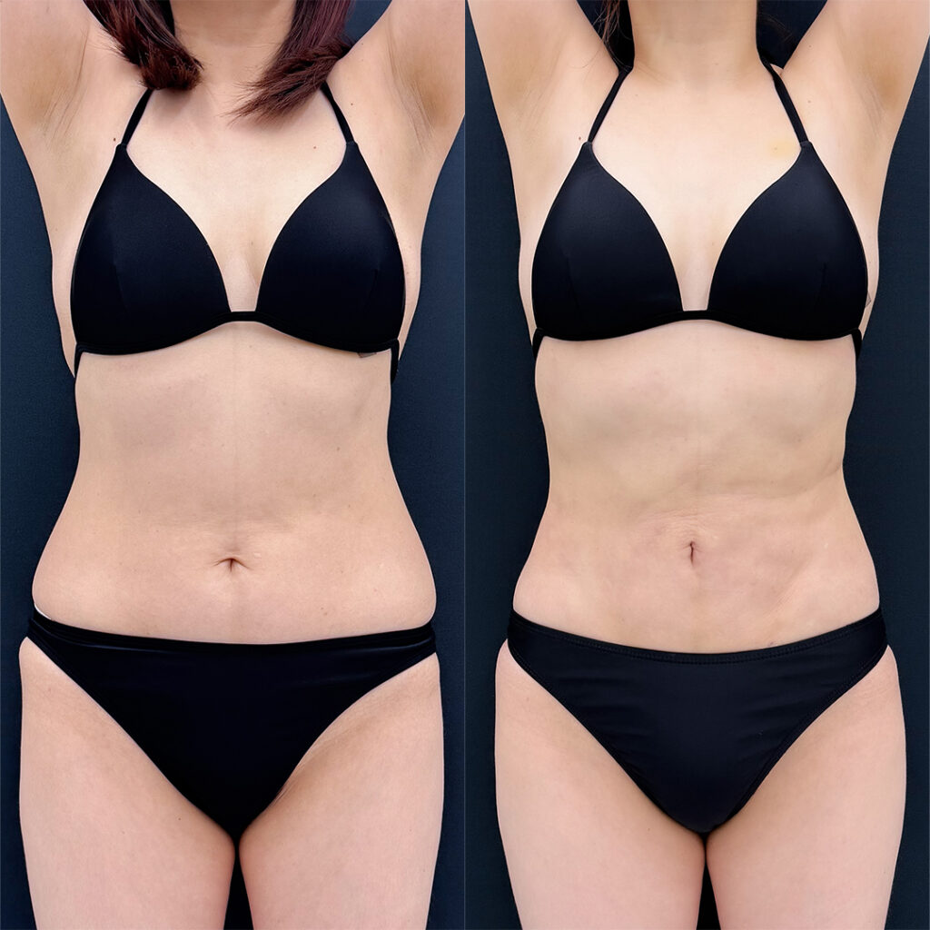 お腹の脂肪吸引