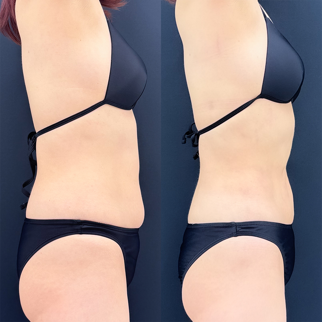 https://purelys-tokyo-clinic.com/wp/wp-content/uploads/2026/03/Before-and-After-abdominal-Liposuction_Case-No.330.jpg