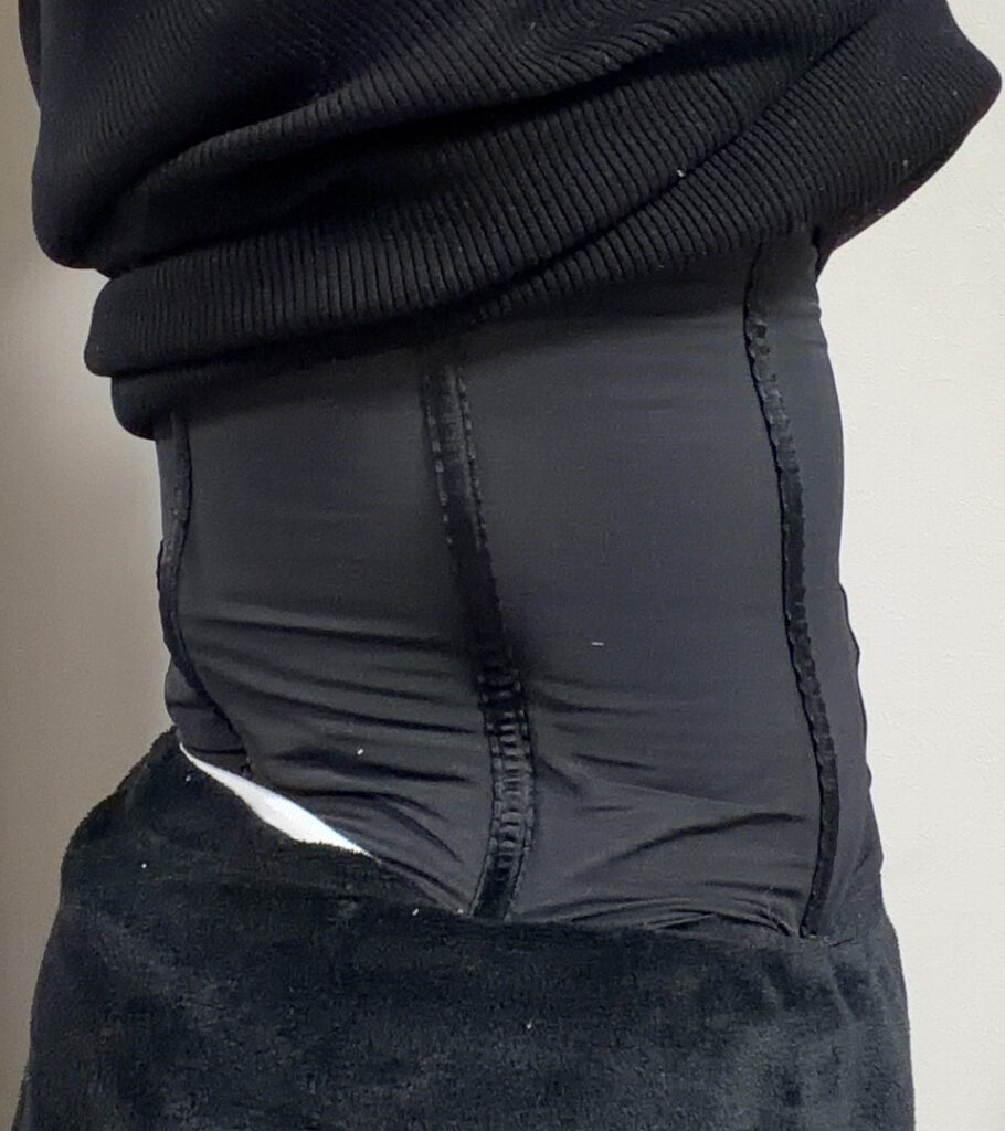 お腹の脂肪吸引