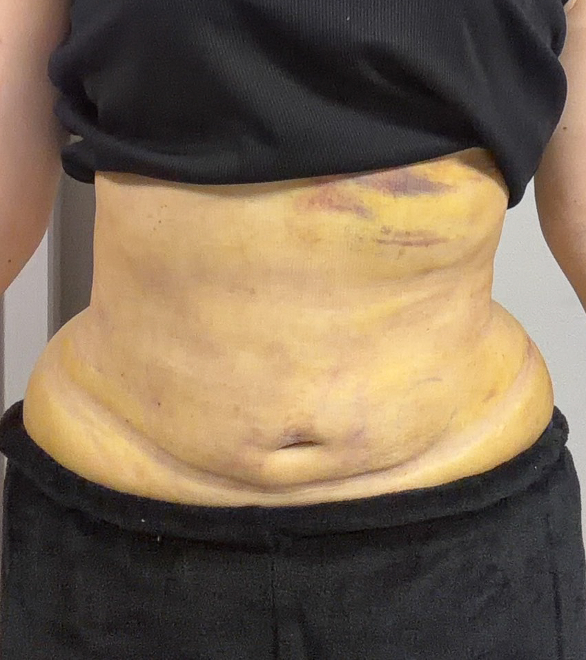 お腹の脂肪吸引