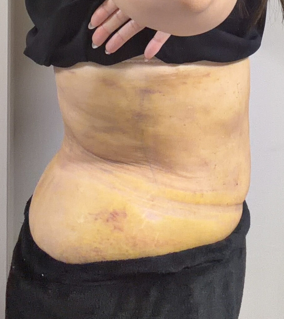 お腹の脂肪吸引