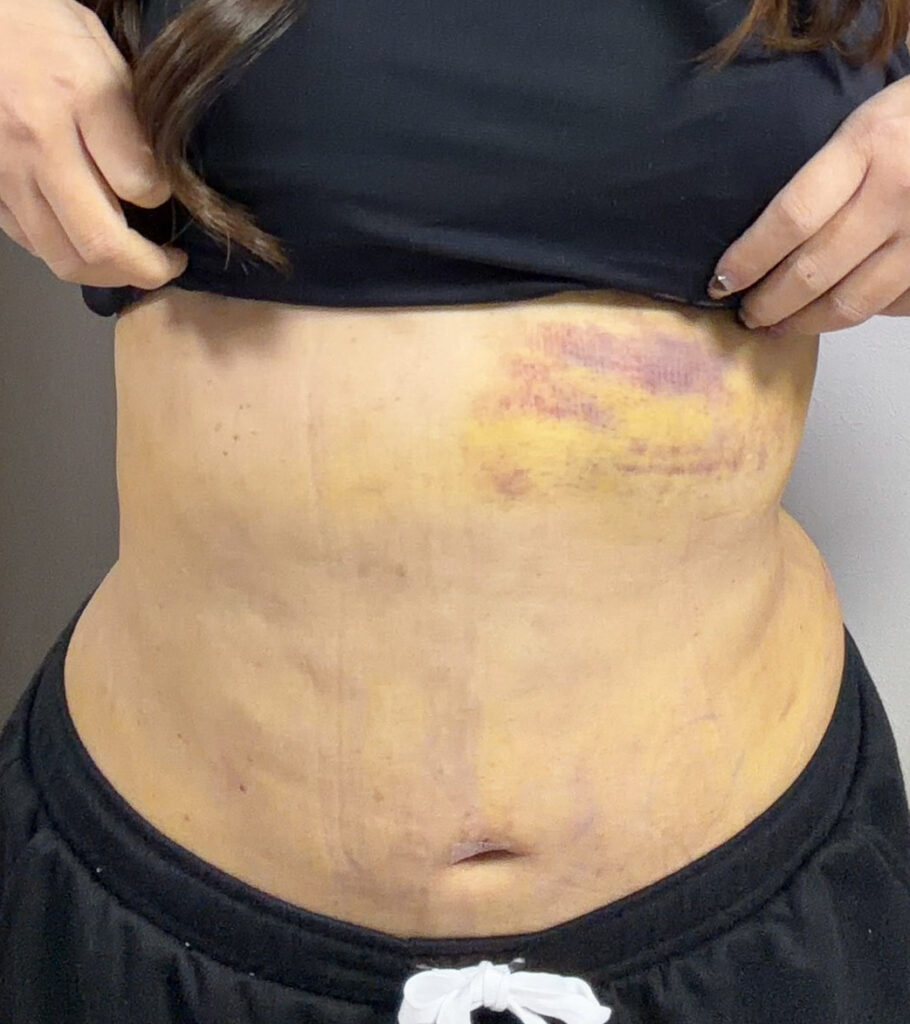 お腹の脂肪吸引