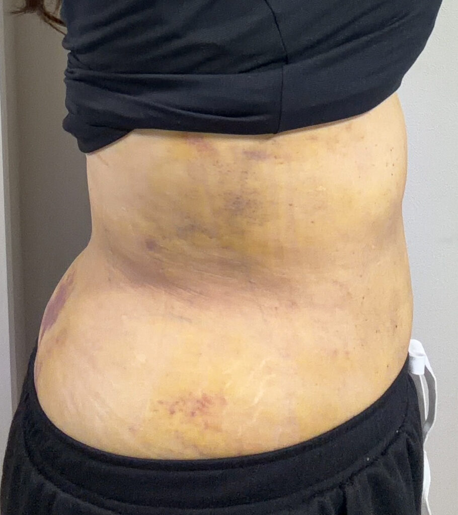 お腹の脂肪吸引