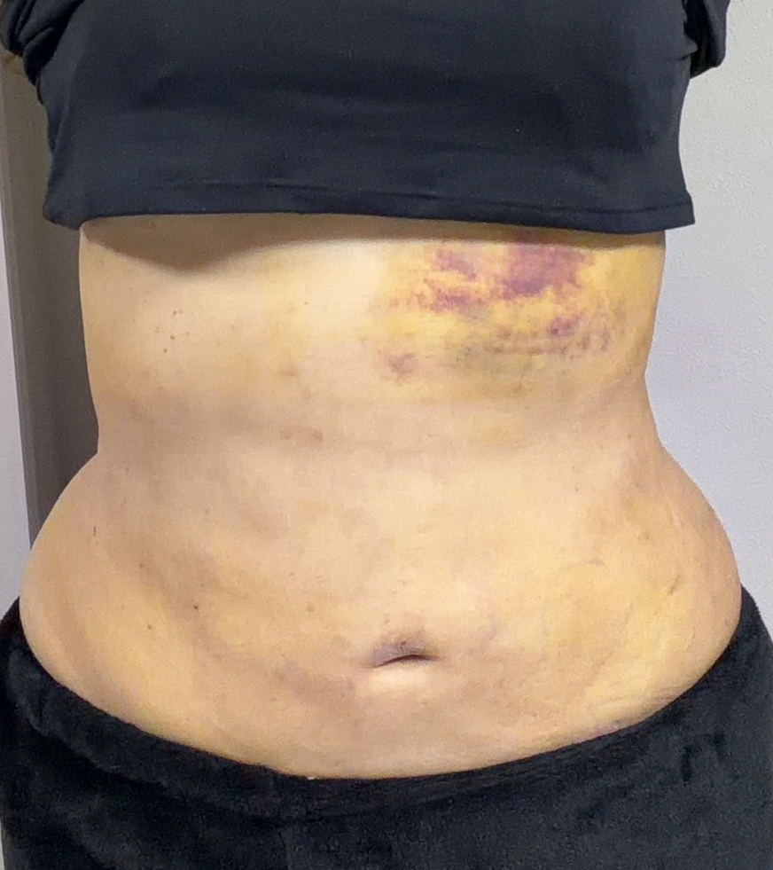 お腹の脂肪吸引