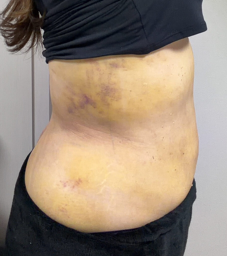 お腹の脂肪吸引