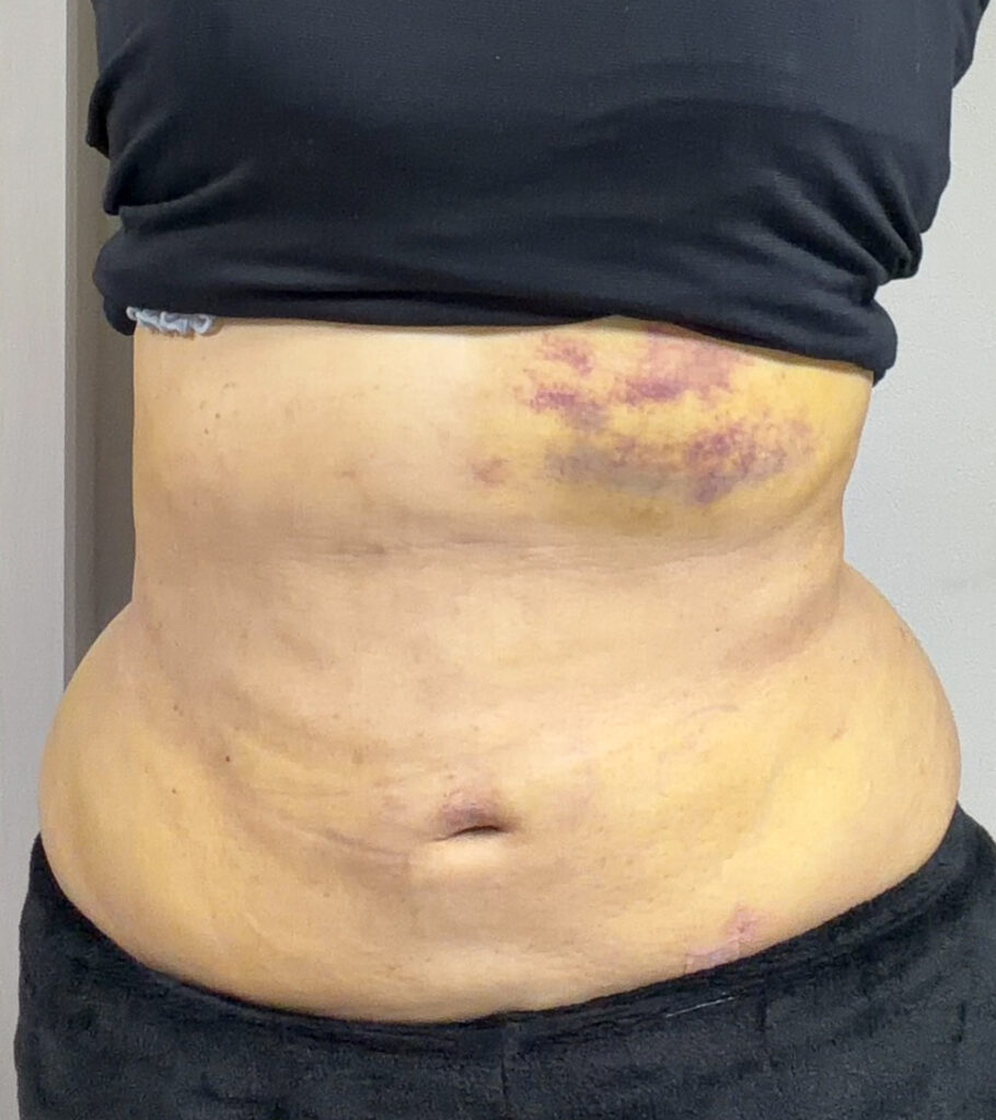 お腹の脂肪吸引