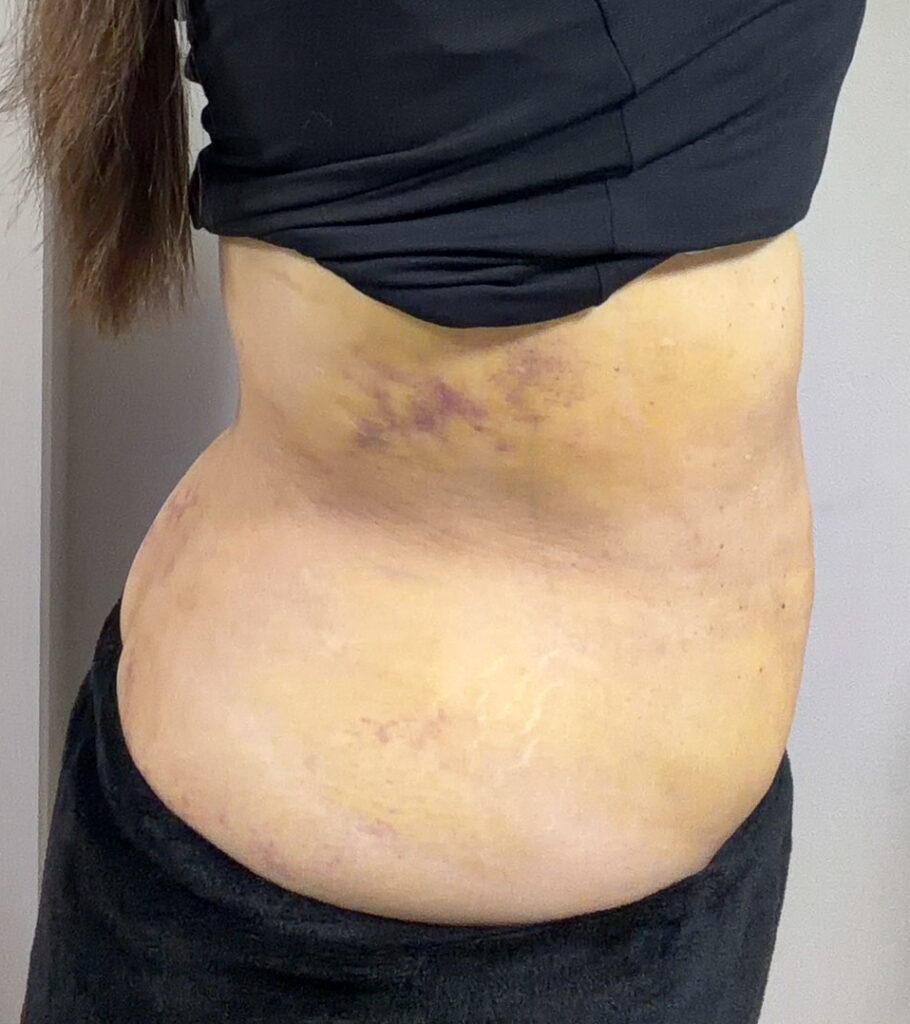 お腹の脂肪吸引