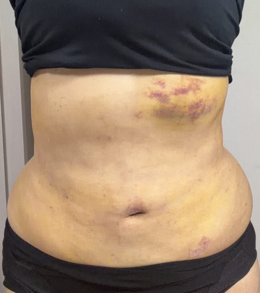 お腹の脂肪吸引