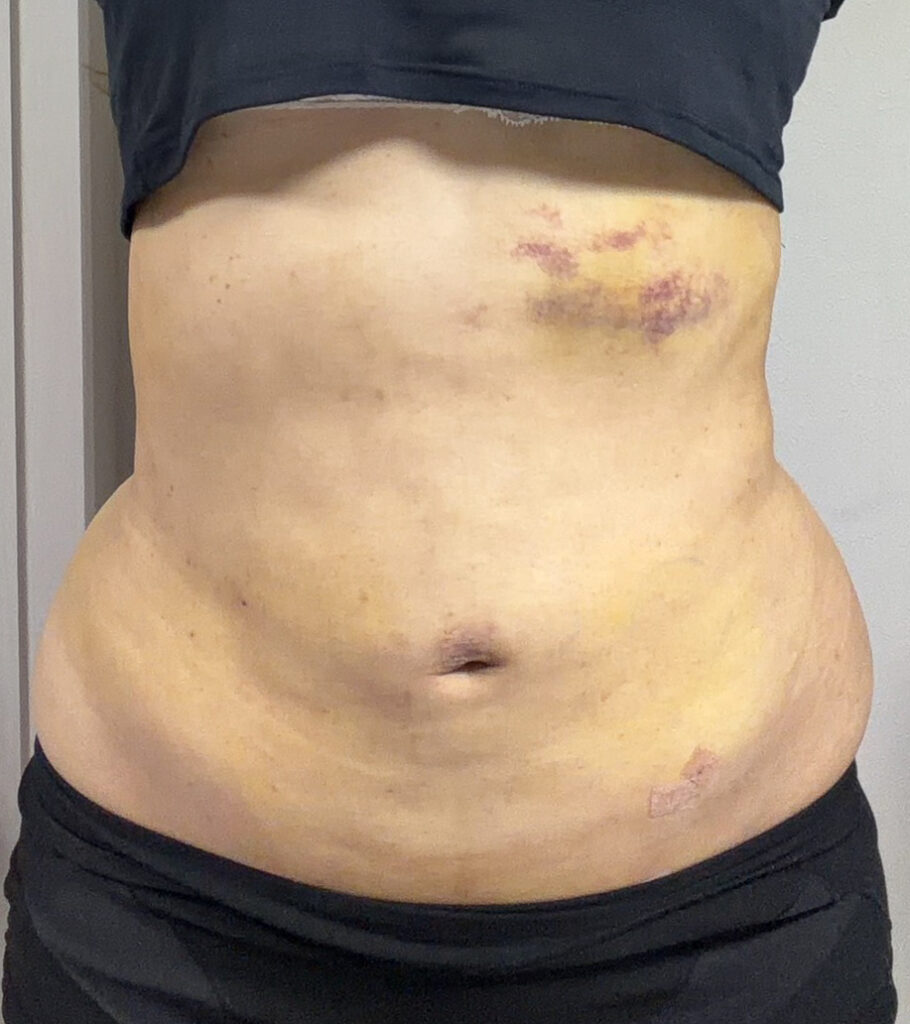 お腹の脂肪吸引