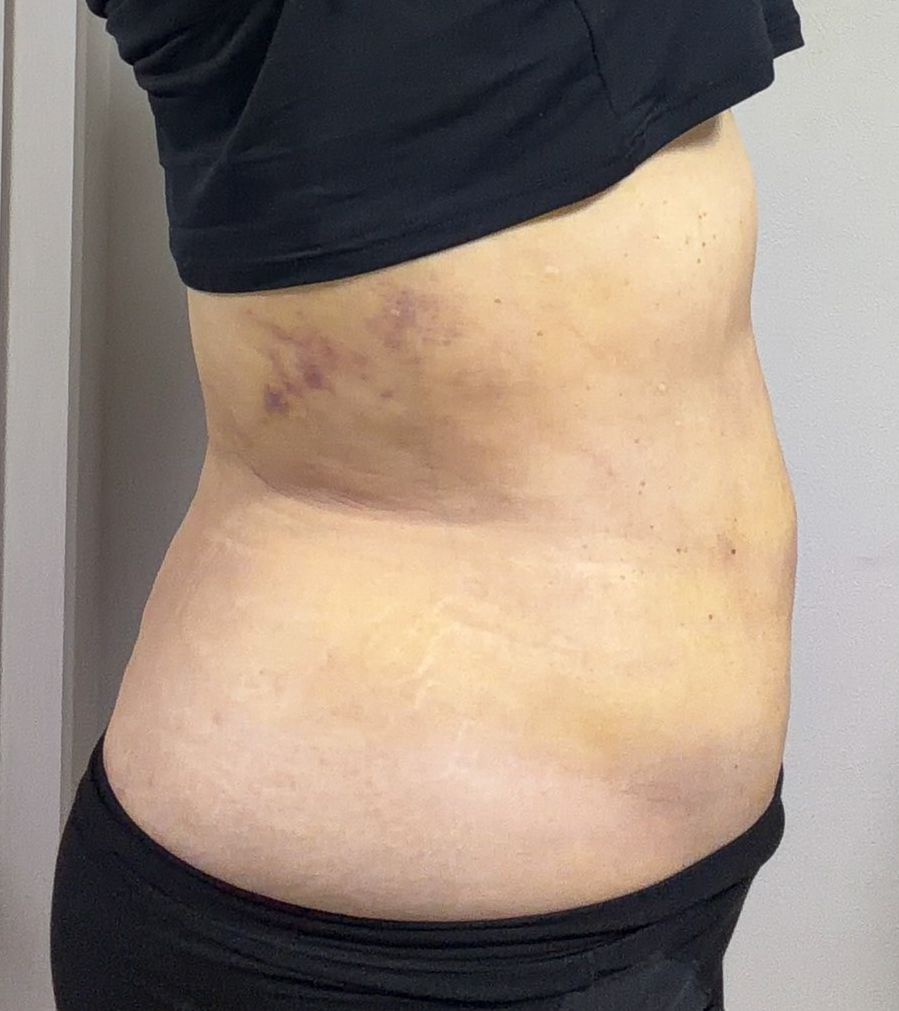 お腹の脂肪吸引