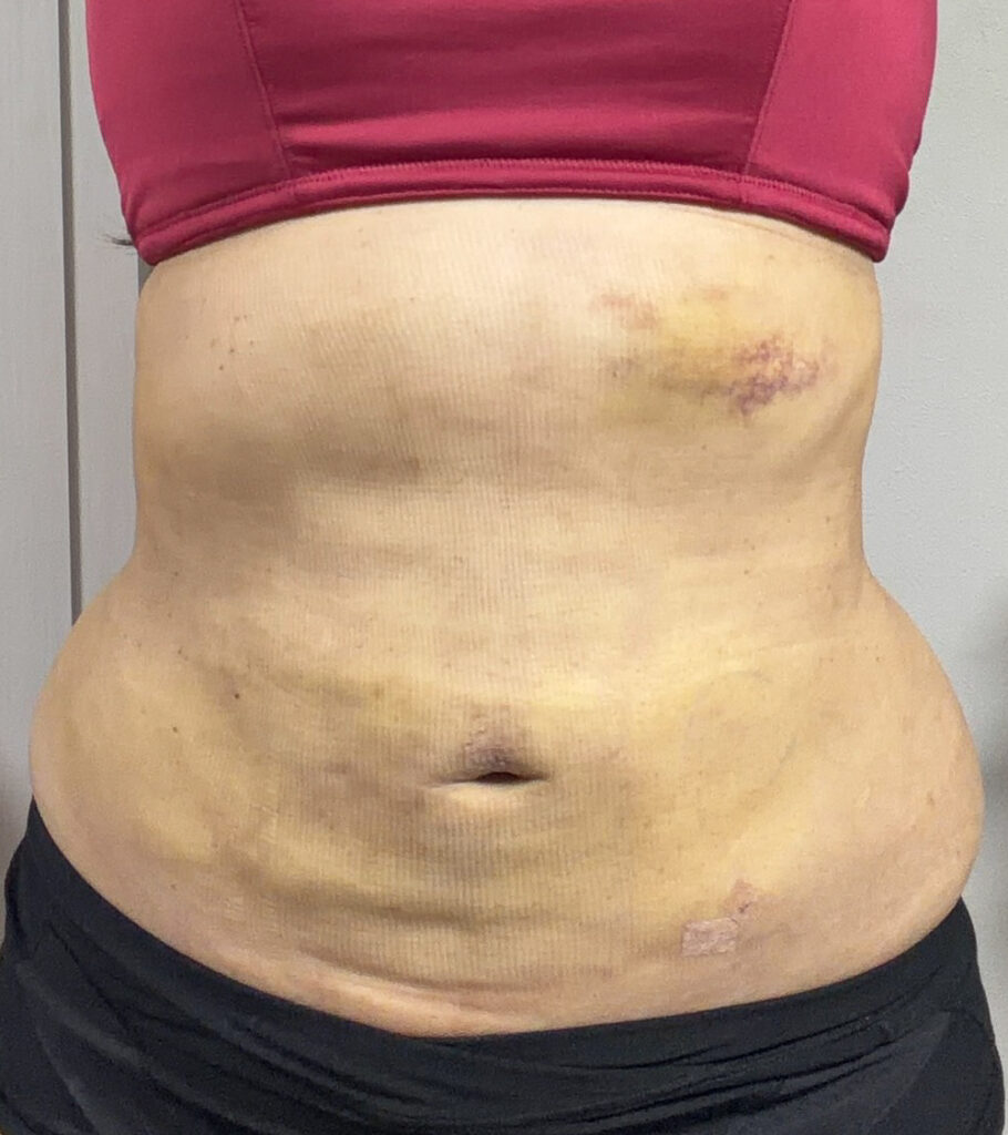 お腹の脂肪吸引