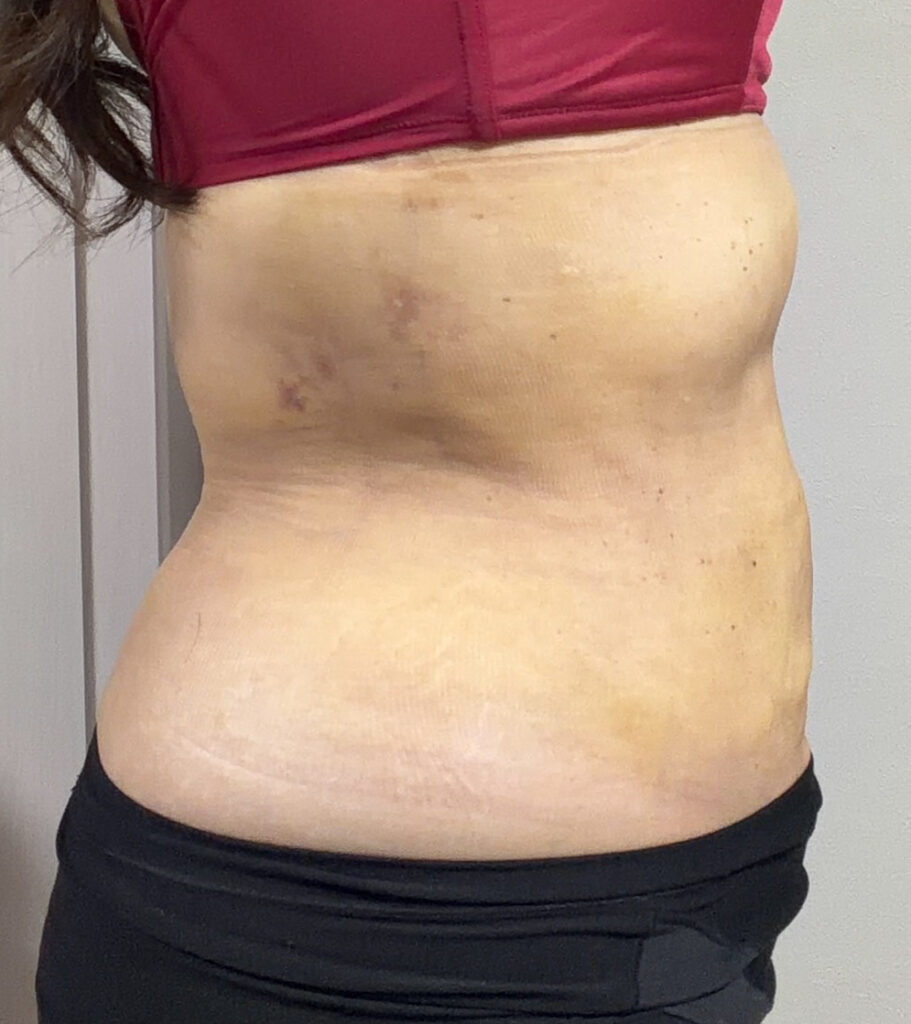 お腹の脂肪吸引