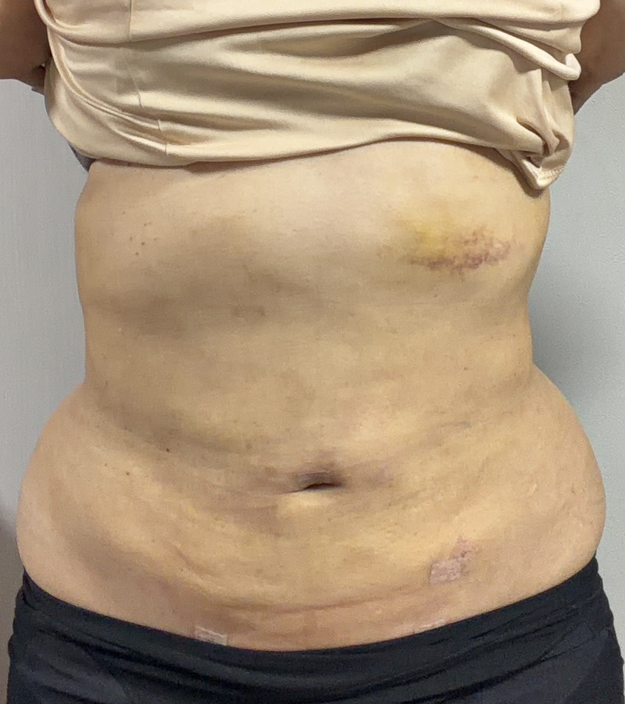 お腹の脂肪吸引