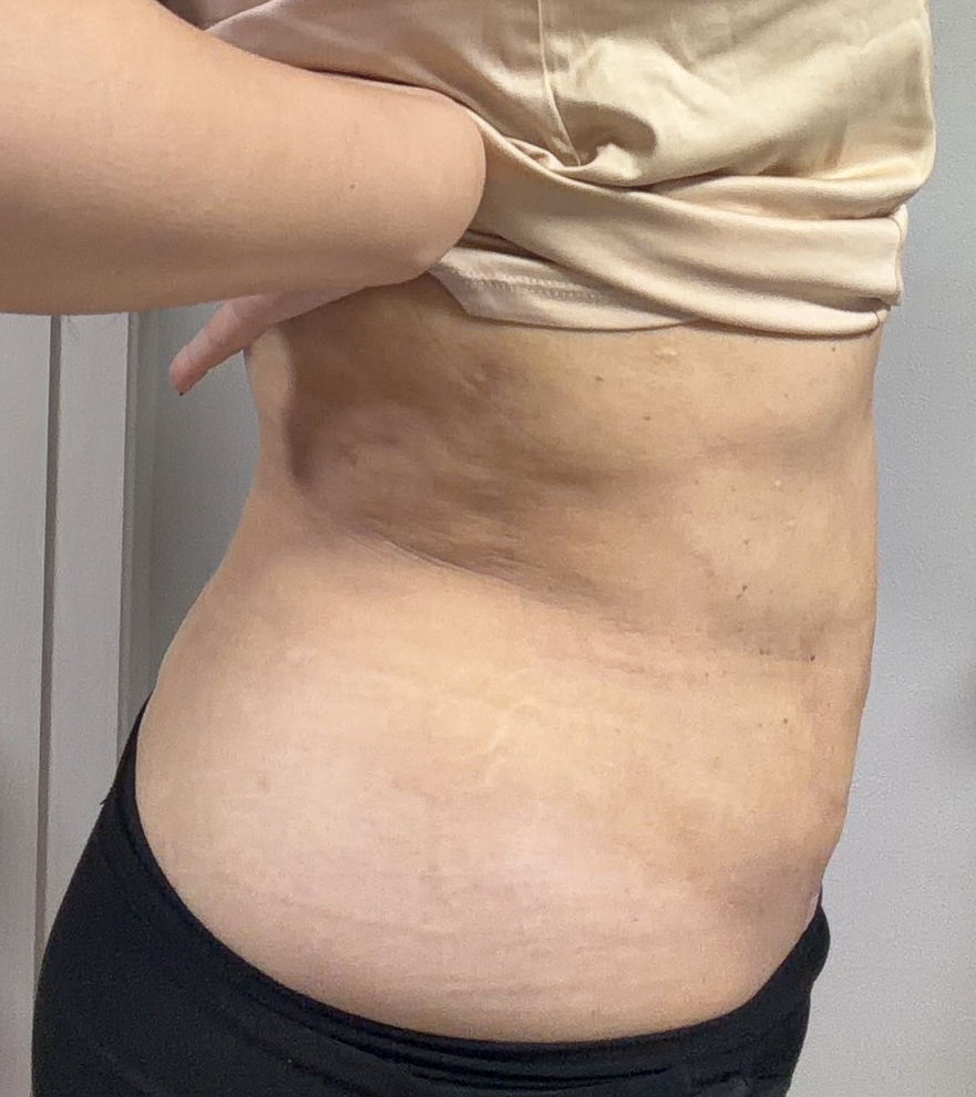 お腹の脂肪吸引