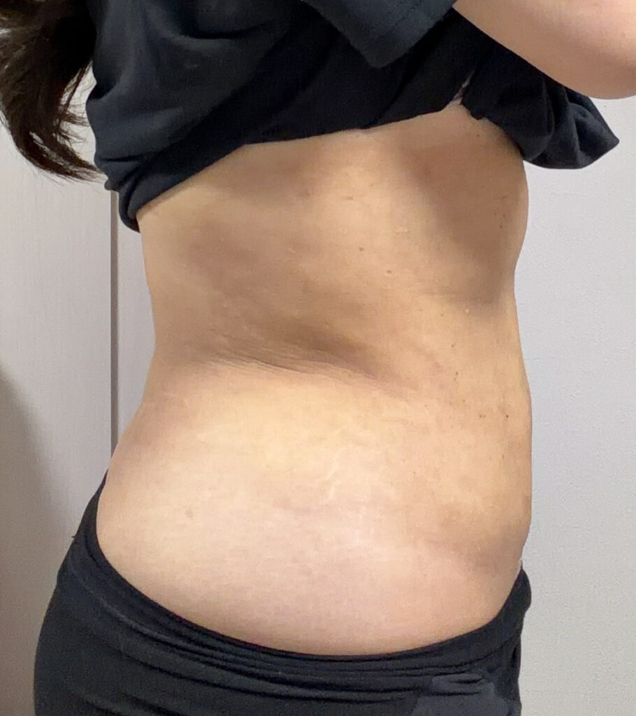 お腹の脂肪吸引
