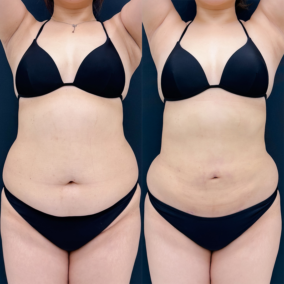 お腹の脂肪吸引